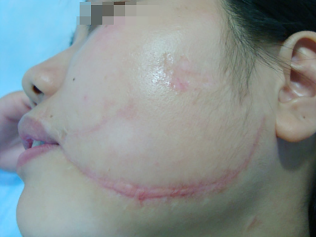 增生性疤痕又痒又痛该怎么办?